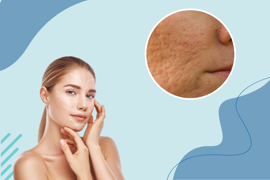 Red light therapy for scars