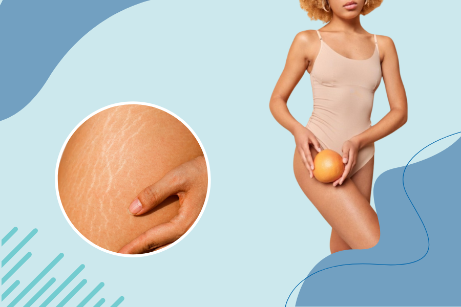 Red Light therapy for stretch marks