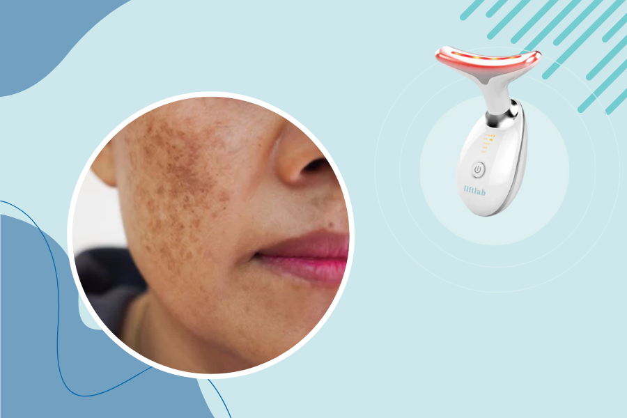 red light therapy for hyperpigmentation
