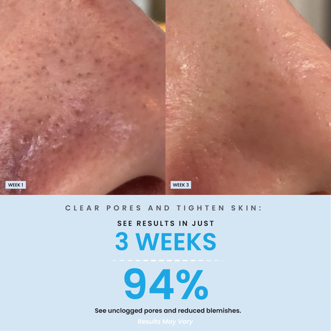 BHA Salicylic Blackhead Exfoliator Result