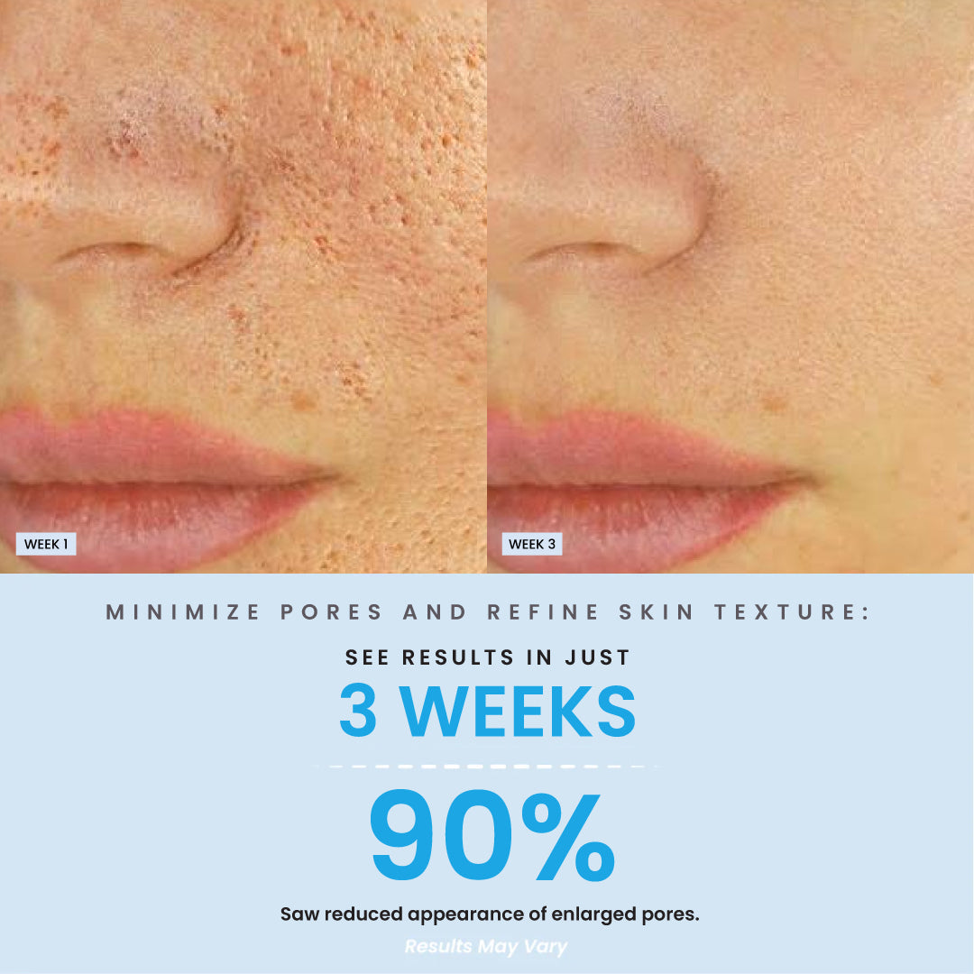 BHA Salicylic Blackhead Exfoliator Result