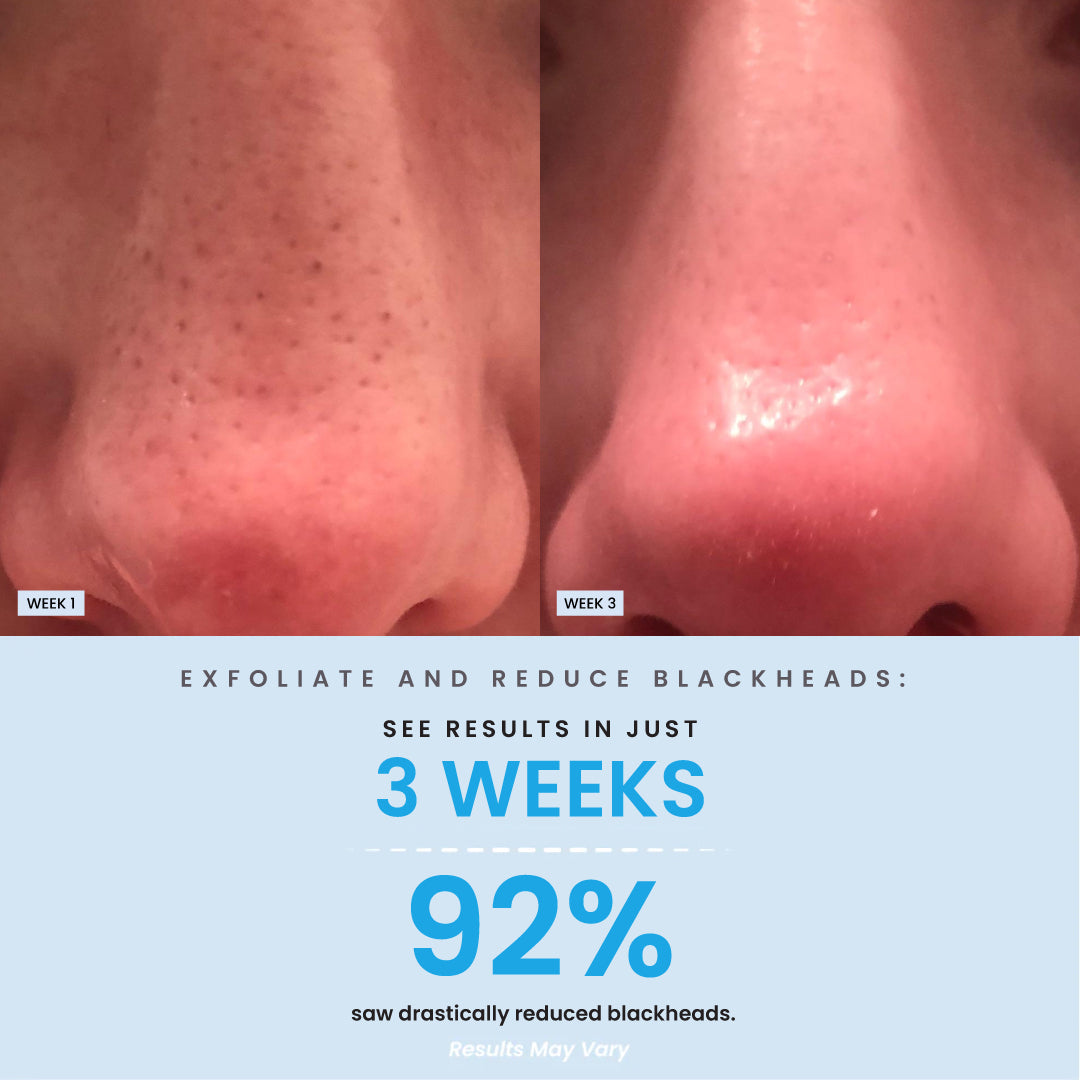 BHA Salicylic Blackhead Exfoliator Result