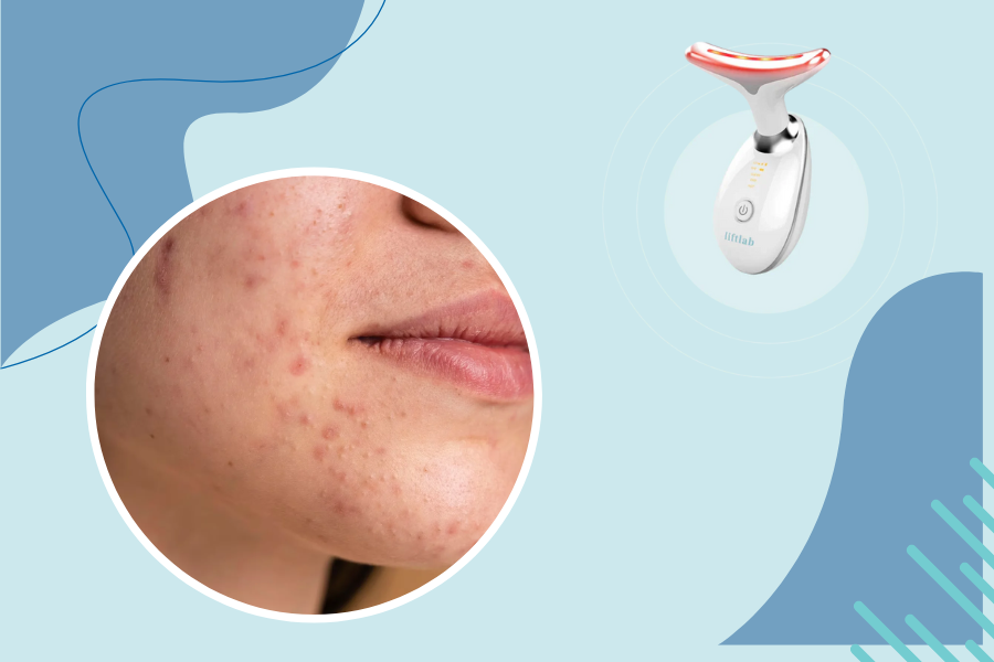 red light therapy for acne